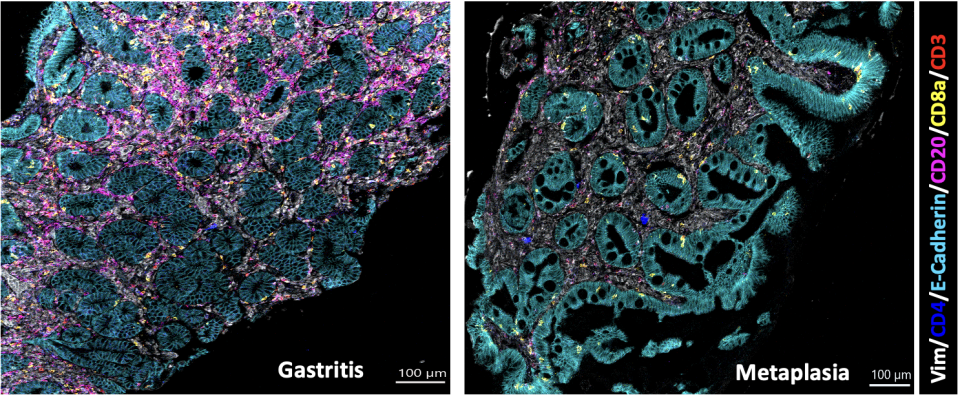 A multiplex IF staining of a tumor tissue sections highlighting cell types of the microenviroment